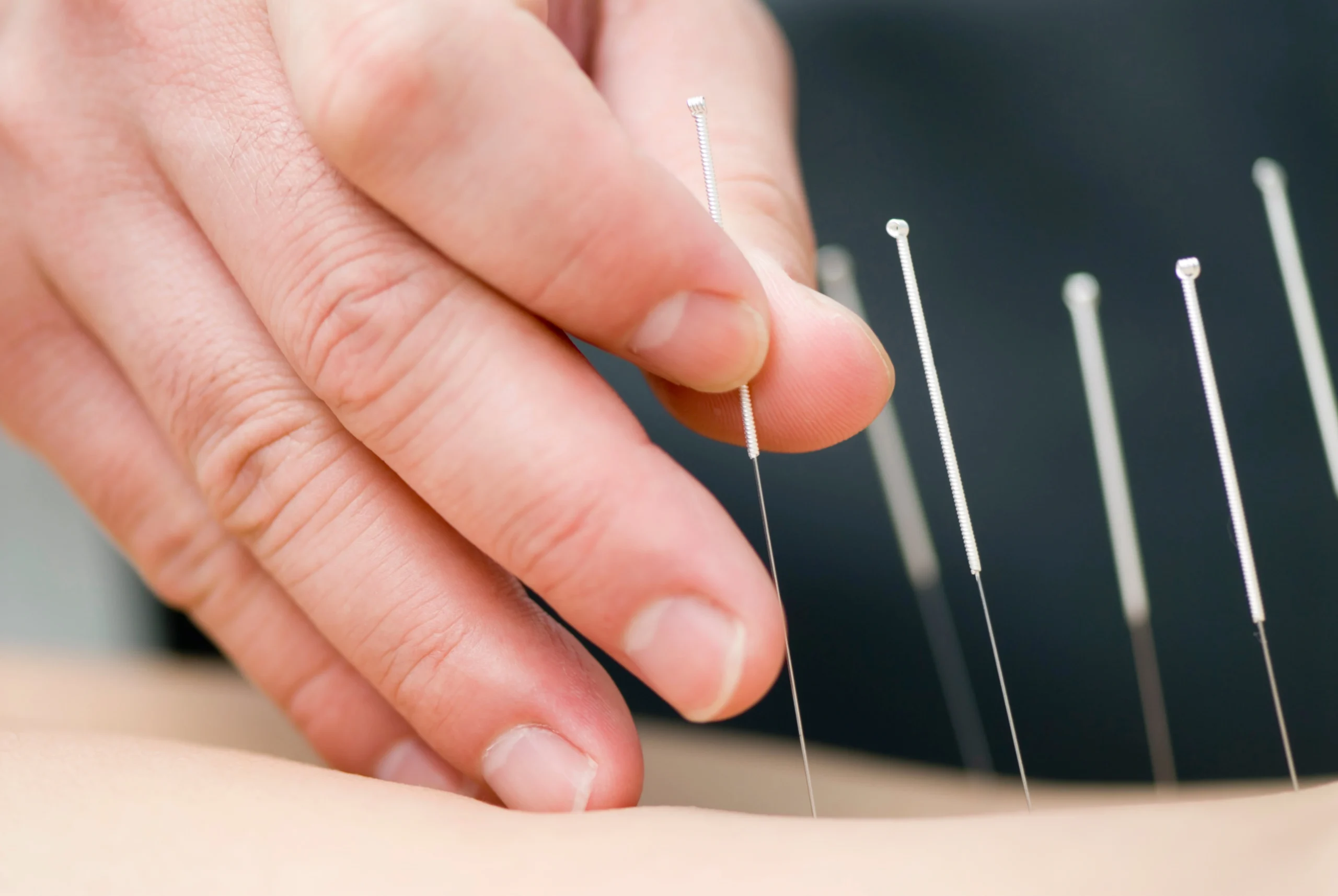 Acupuncture needles | Canvas Skin Clinic | Tampa, FL
